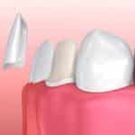 Wie lange halten Veneers