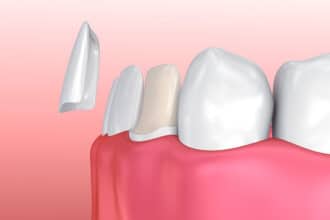 Wie lange halten Veneers