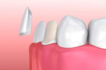 Wie lange halten Veneers